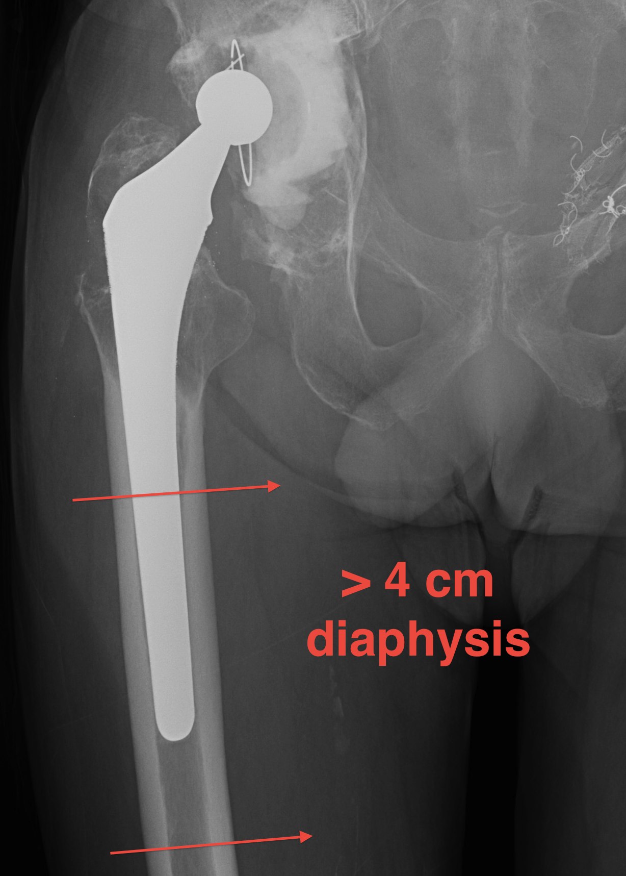 Revision THR Paprosky IIIA Femur